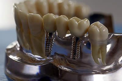 зубное протезирование